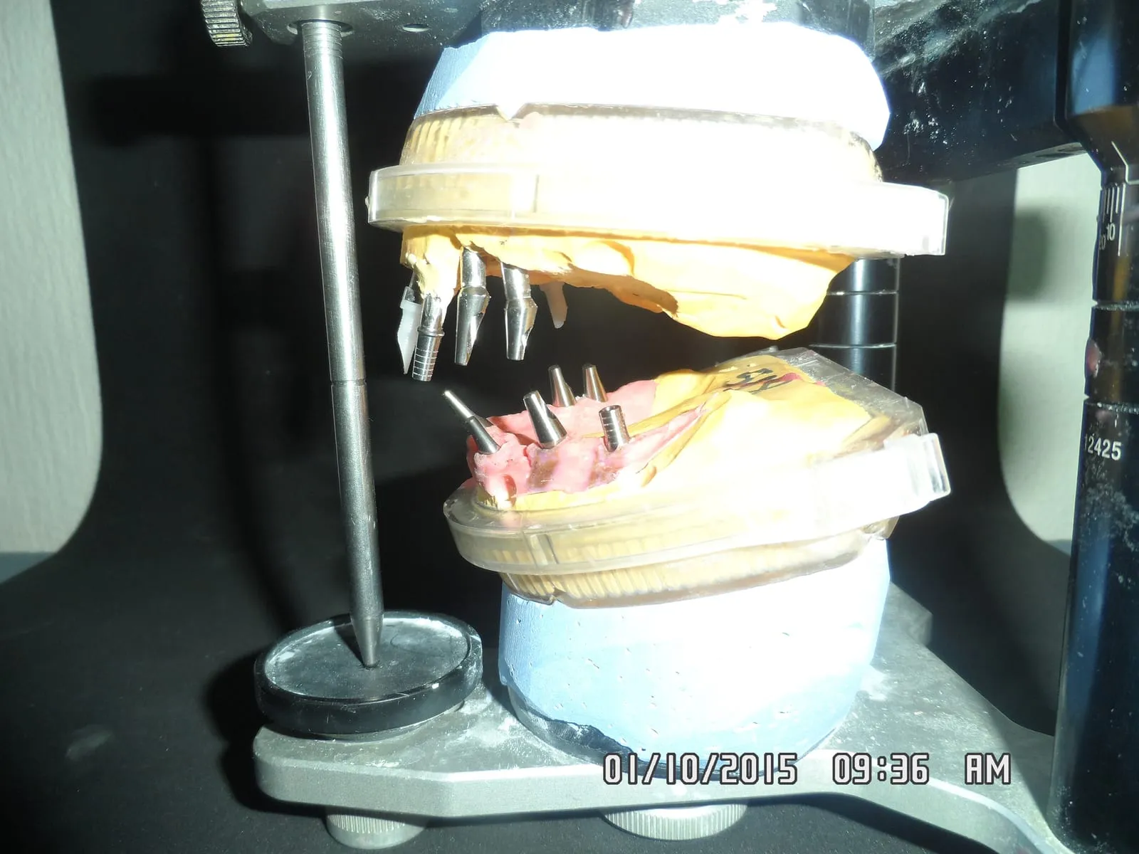 Implant-supported