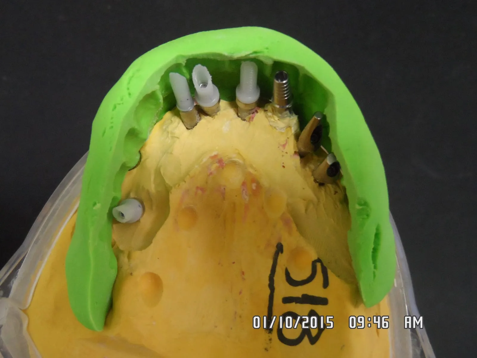 Implant-supported