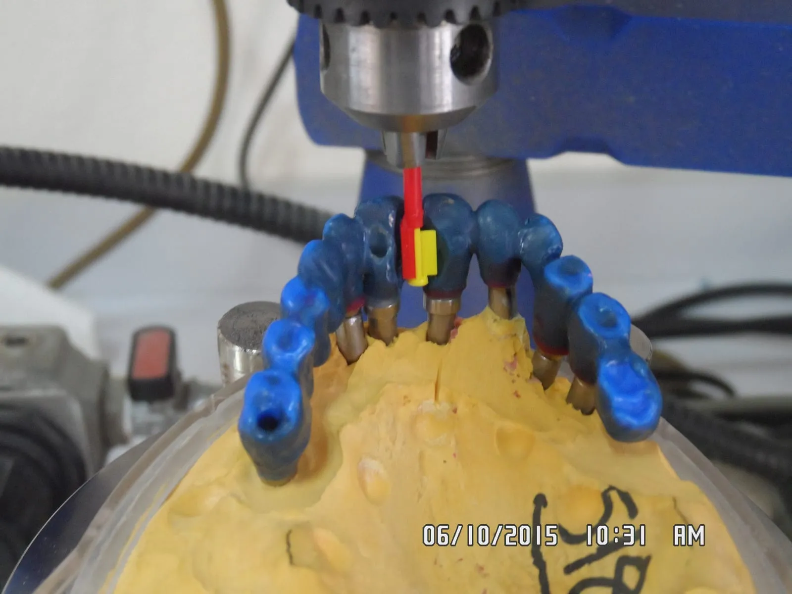 Implant-supported