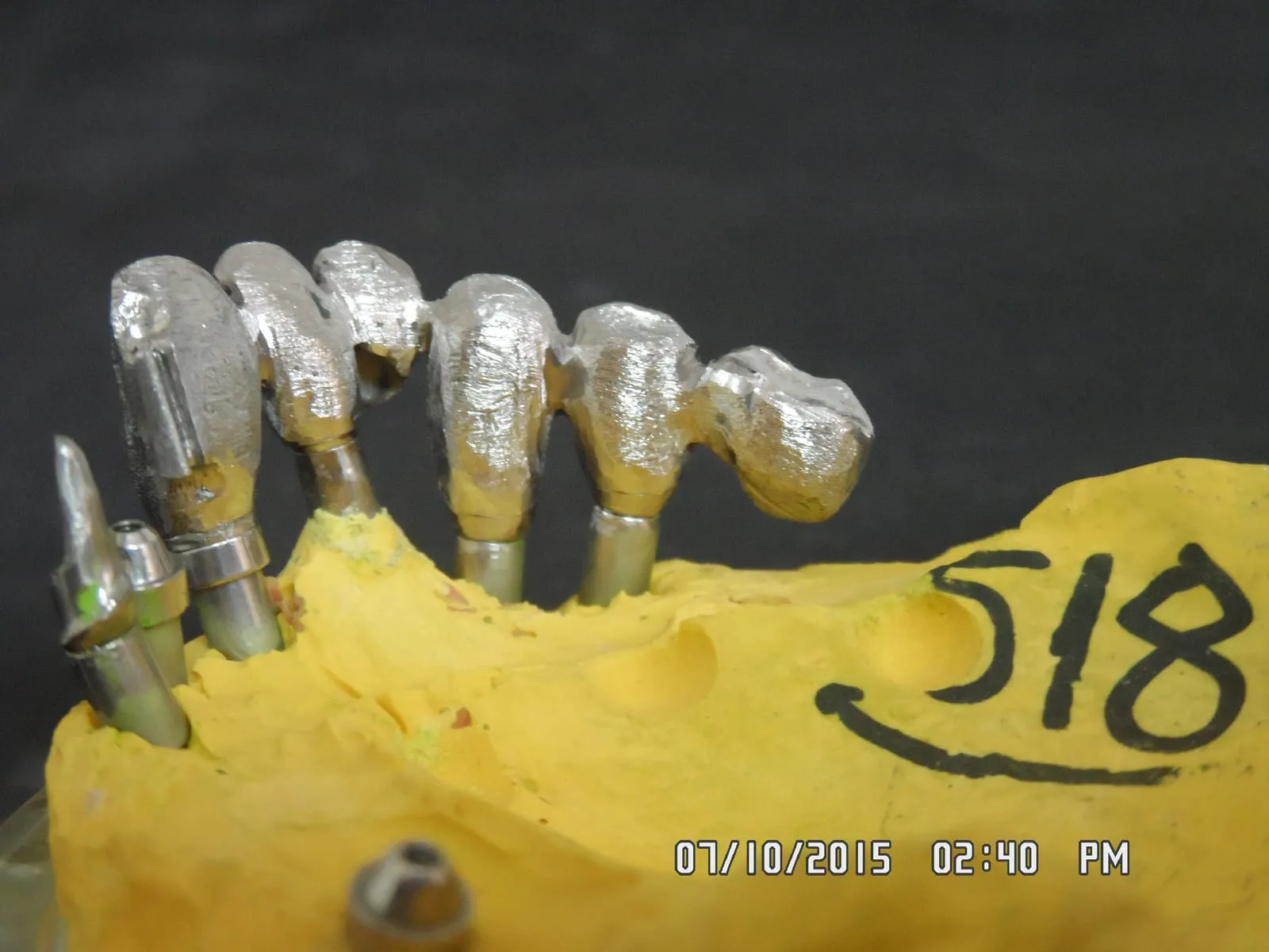 Implant-supported