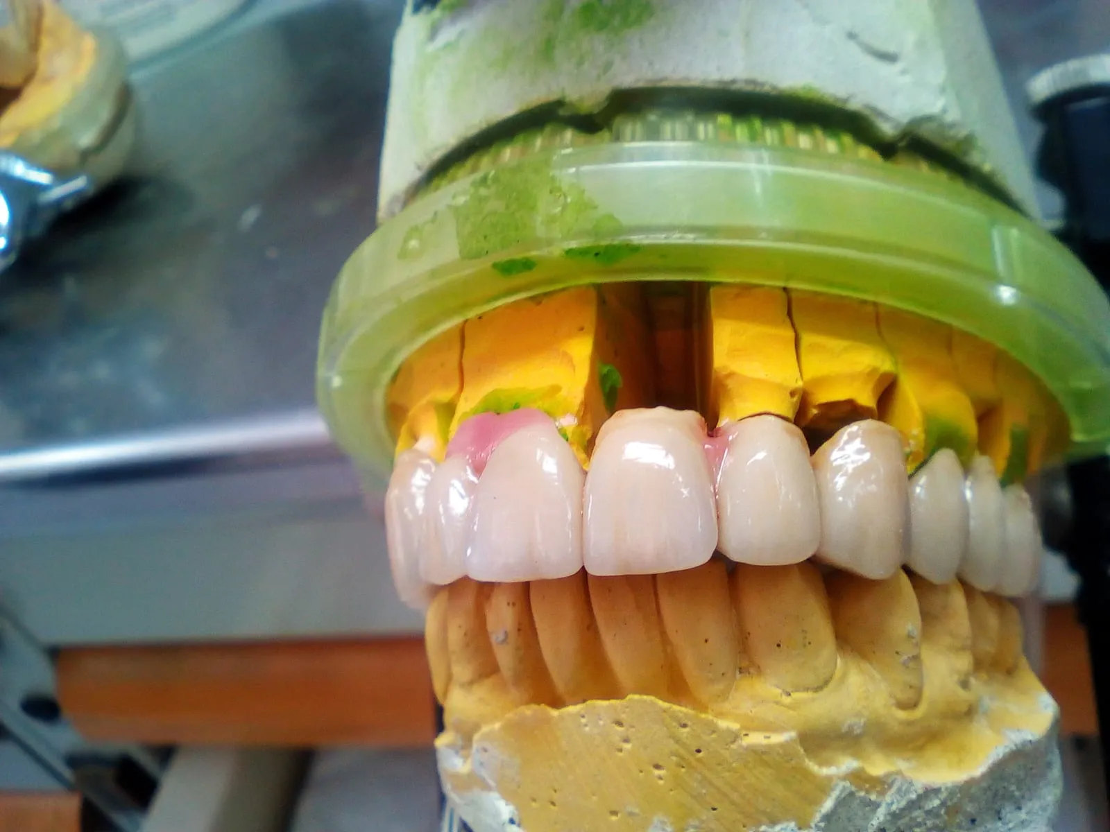 Metal-ceramic