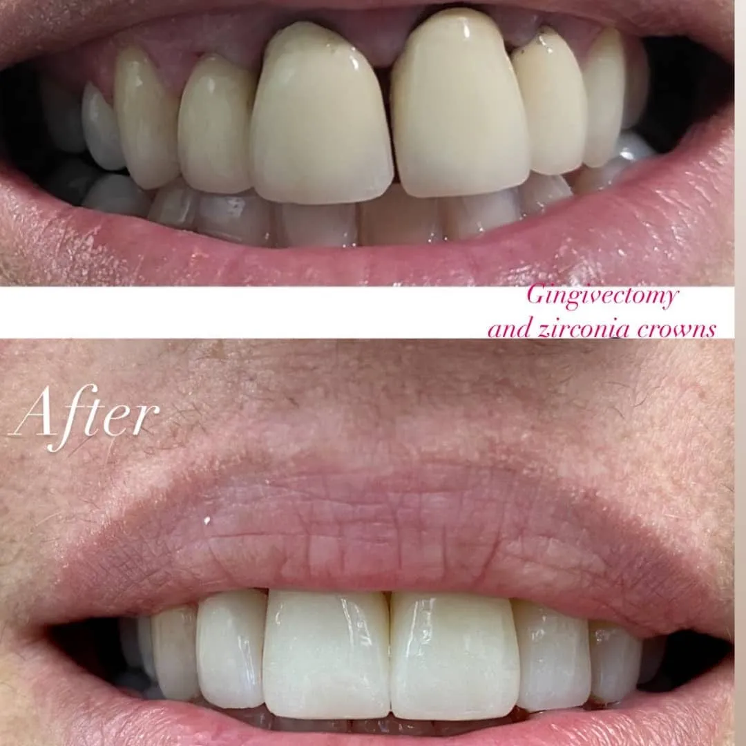 Zirconia